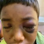 CG NEWS : ब्लैक फंगस का कहर, 5 वर्षीय बच्चे की आँखों में दिखा फंगस का लक्षण