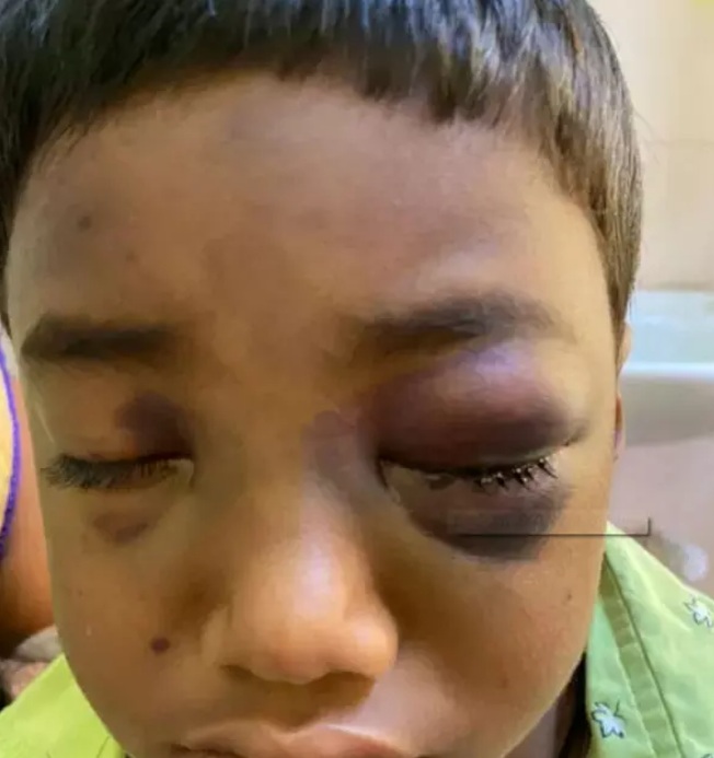 CG NEWS : ब्लैक फंगस का कहर, 5 वर्षीय बच्चे की आँखों में दिखा फंगस का लक्षण