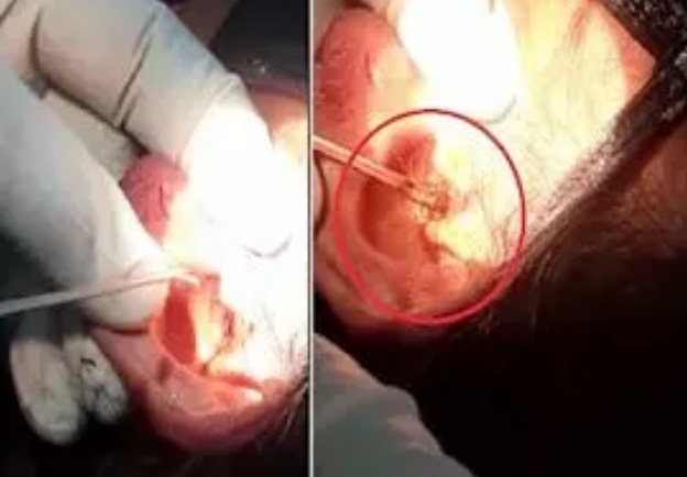 CG NEWS : महिला के कान का ऑपरेशन कर डॉक्टर्स हुए हैरान, कान से निकला जिंदा झींगुर कीड़ा 