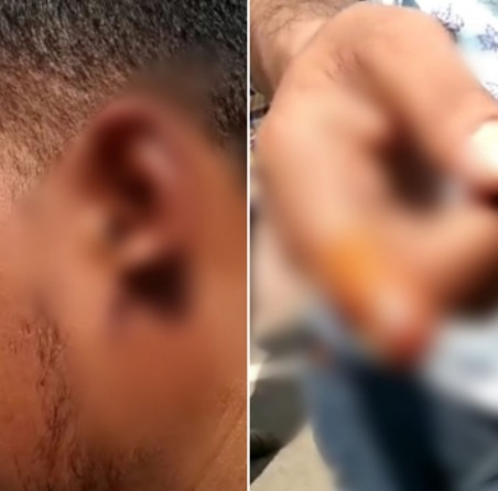 CG CRIME NEWS : मामूली विवाद में दातों से काटा 2 लोगों की उंगली और कान, कटकर हुआ अलग