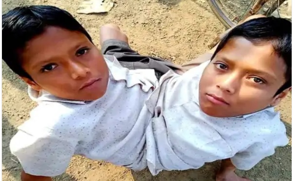 'दो जिस्म एक जान', मशहूर जुड़वा भाई शिवराम और शिवनाथ की, संदिग्ध मौत से हड़कंप