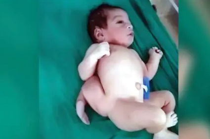 गांव में जन्मा चार पैर वाला बच्चा, देखने जुटी लोगों की भीड़, डॉक्टरों ने बताया लाखों में एक  