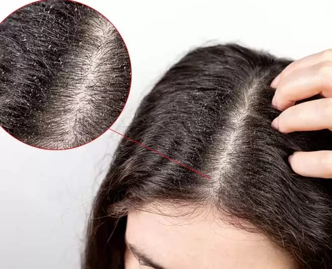 Hair Care: If you are troubled by dandruff in hair, then adopt these tips today itself, there will be no problem of dandruff
