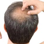 Home Remedies for Hair Fall : क्या आप भी हैं बाल झड़ने की समस्या से परेशान ! तो करें यह समाधान