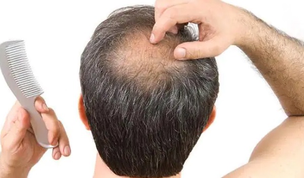 Home Remedies for Hair Fall : क्या आप भी हैं बाल झड़ने की समस्या से परेशान ! तो करें यह समाधान