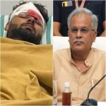  Rishabh Pant Car Accident : हादसे के बाद ऋषभ पंत की हालत गंभीर, की जाएगी प्लास्टिक सर्जरी, CM बघेल ने जल्‍द से जल्द ठीक होने की कामना