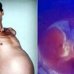 OMG : 36 साल से प्रेग्नेंट रहा शख्स, ऑपरेशन के बाद निकले जुड़वा बच्चे