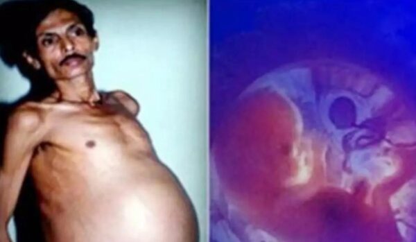 OMG : 36 साल से प्रेग्नेंट रहा शख्स, ऑपरेशन के बाद निकले जुड़वा बच्चे