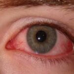 Eye Flu In CG : छत्तीसगढ़ में तेजी से फ़ैल रहा आई फ्लू, आंखों की बीमारी और मौसमी बीमारी के संबंध में संभागीय और जिला शिक्षा अधिकारियों को निर्देश