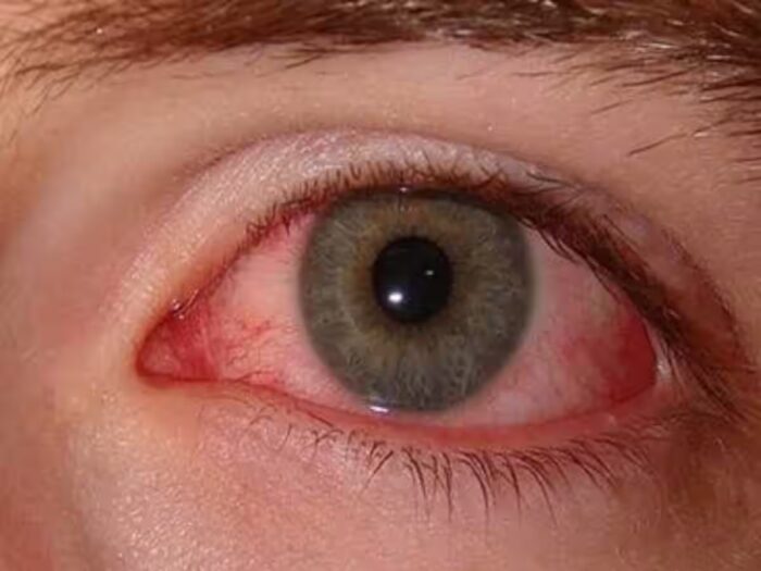 Eye Flu In CG : छत्तीसगढ़ में तेजी से फ़ैल रहा आई फ्लू, आंखों की बीमारी और मौसमी बीमारी के संबंध में संभागीय और जिला शिक्षा अधिकारियों को निर्देश