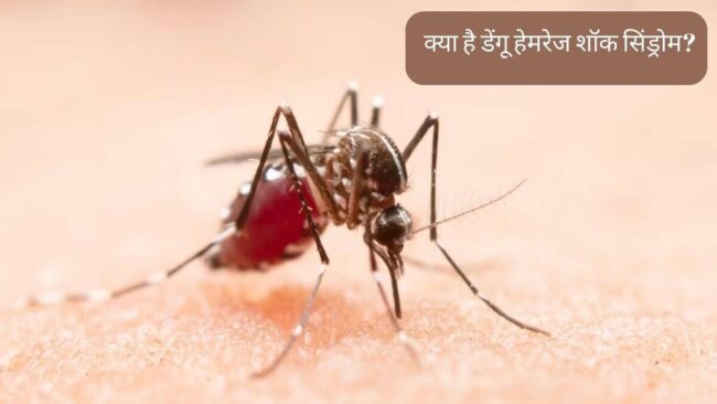 Dengue : डेंगू को हल्के में न लें, इस स्टेज में जा सकती है जान, जानें लक्षण और सावधानियां
