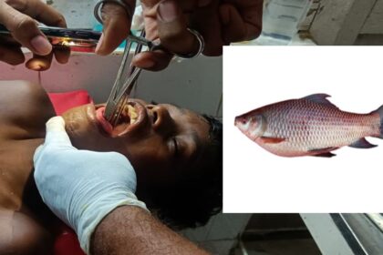 CG AJAB GAJAB NEWS : नहाते समय बच्चे के मुँह में फंसी जिन्दा FISH..., निकालने में डॉक्टरों के छूटे पसीने 