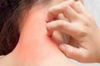 Lifestyle : गर्मियों में फंगल इंफेक्शन से बचने के घरेलू नुस्खे, उपायों से मिलेगी राहत