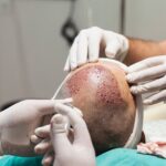 BIG NEWS: हेयर ट्रांसप्लांट में इंफेक्शन, बाल उगाने की चाहत में इंजीनियर की मौत