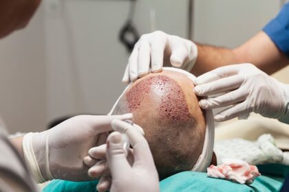 BIG NEWS: हेयर ट्रांसप्लांट में इंफेक्शन, बाल उगाने की चाहत में इंजीनियर की मौत